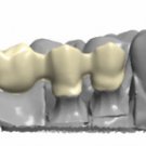 Porcelain Fused To Zirconia