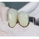 Fixed Restoration Implant Crown