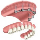 Removable Prosthetic Implant Overdentures