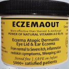 Intense Treatment for Eczema Rosacea cream Eczemaout Acne 4oz