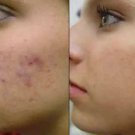 AWESOME SNAIL EXTRACT ANTI AGEING BLACKHEAD ACNE SCAR STRETCH MARK REPAIR CREAM