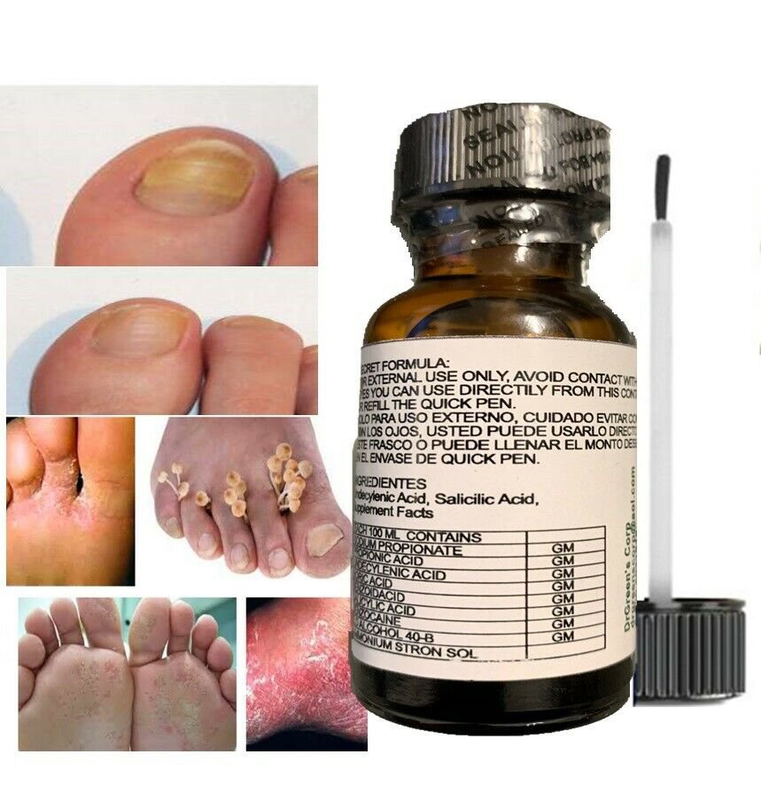 Fungi Athlete's Foot Antifungal Treatment Jock Itch Ringworm Itching