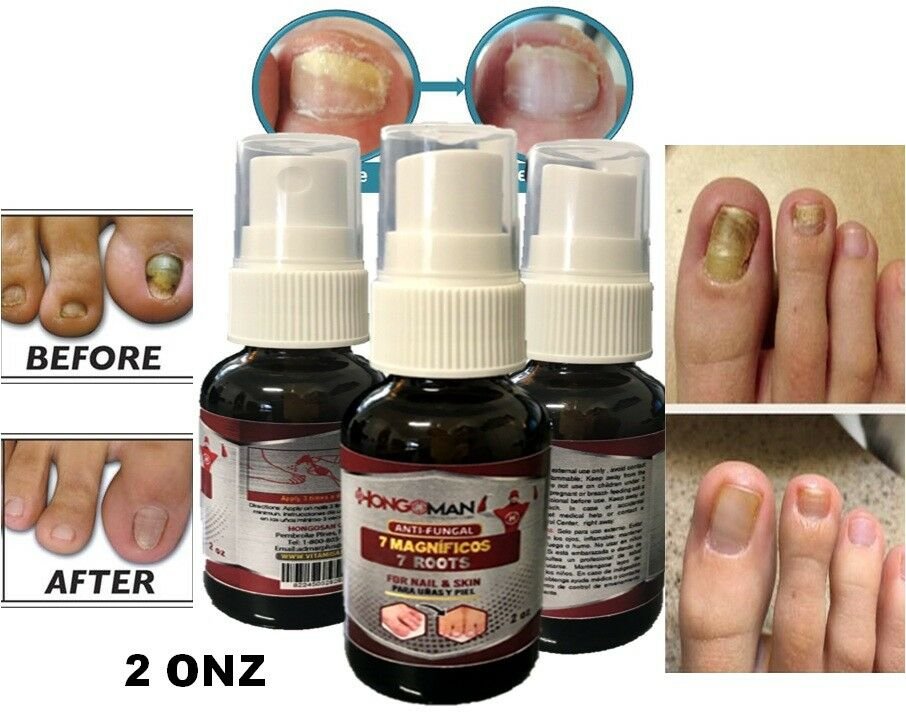 ANTI-FUNGAL MAXIMUM STRENGTH TOENAIL FUNGUS ATHLETES FOOT FUNGI 2 NAIL ...