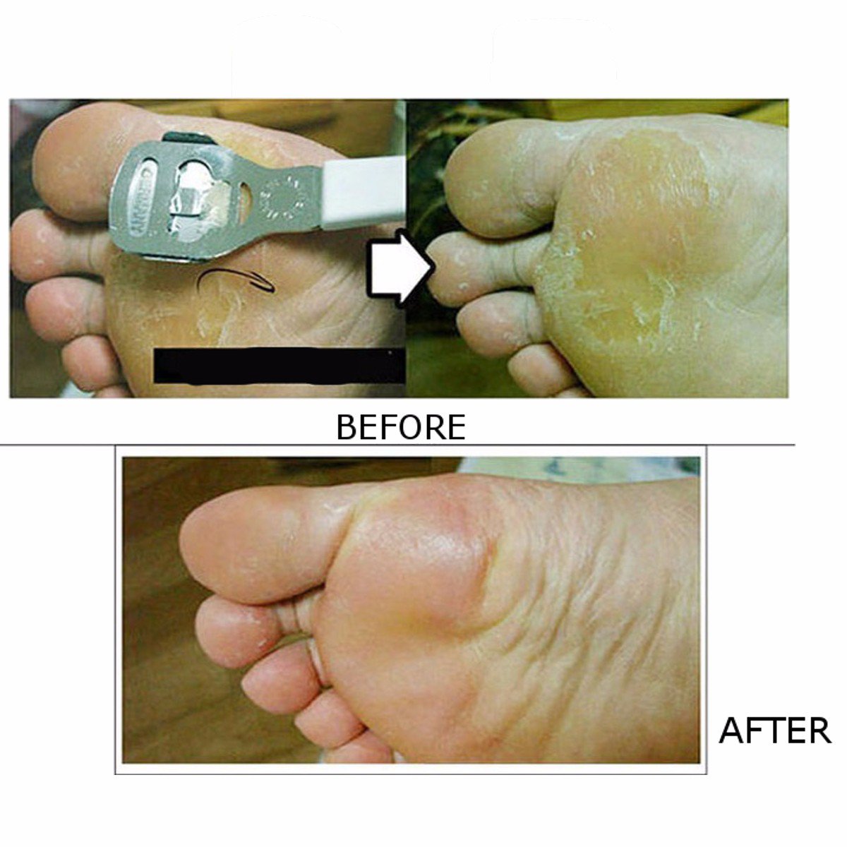 Foot Hard Skin Scraper Remover Pedicure Care Set Feet Callus Corn Shaver Blades