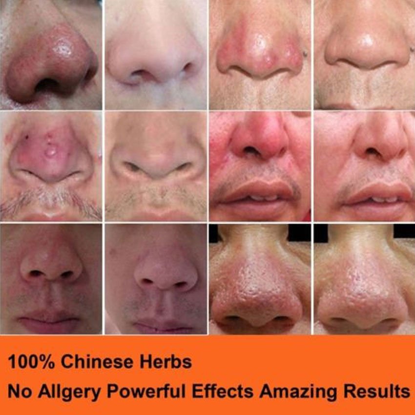 Rosacea cream Red nose ointment remove blackhead acne cream Skin care