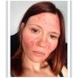 Rosacea cream Red nose ointment remove blackhead acne cream Skin care