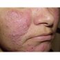 Rosacea cream Red nose ointment remove blackhead acne cream Skin care