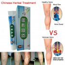 Effective treatment of varicose veins of lower limb pain and itching of the oint