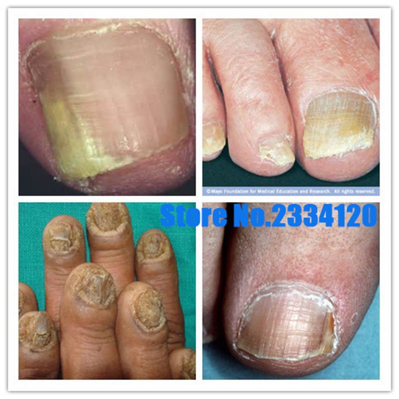 Chinese Medicine Herbs Toe Nail Fungus Treatment Anti Fungal Nail