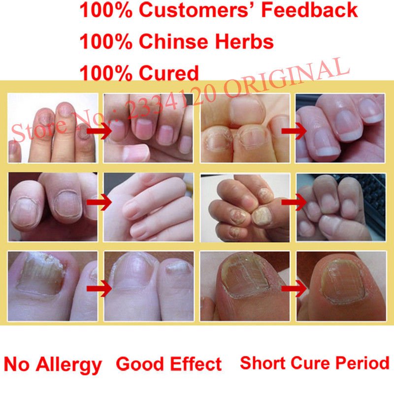 Chinese Medicine Herbs Toe Nail Fungus Treatment Anti Fungal Nail