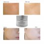 Strong Effects Whitening Freckle Remove Melasma Acne Treatment of pigmentation