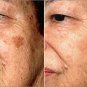 Strong Effects Whitening Freckle Remove Melasma Acne Treatment of pigmentation