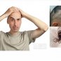 minoxidil man women 5% High effective faster Grow hair, Hair Growth Stop Loss
