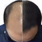 minoxidil man women 5% High effective faster Grow hair, Hair Growth Stop Loss
