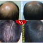 minoxidil man women 5% High effective faster Grow hair, Hair Growth Stop Loss
