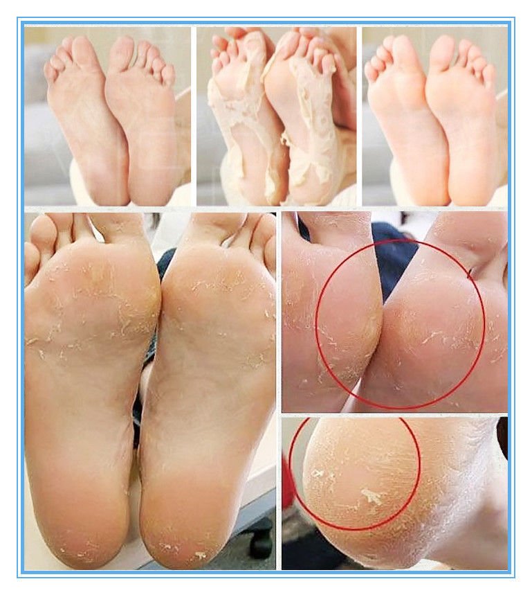 Foot Dead Skin Removal - Smooth Peeling Mask