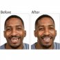 Instant Smile Veneer - SAVE 60% TODAY The Original