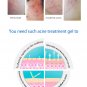 Acne Treatment Gel Cream FAST RELIEF Inflammation cystic pimple face Skin Care