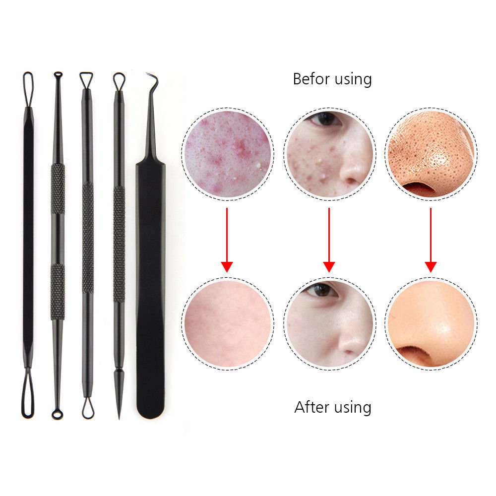 5Pcs Blackhead Acne Comedone Pimple Blemish Extractor Remover Tool Kit Set Black