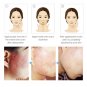 Face Skin Care Acne Removal Cream Scar Blemish Marks Authentic For Man&Women New