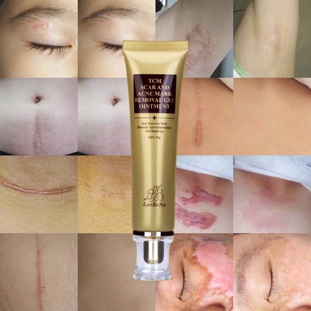 Scar Remover Serum Acne Scars And Stretch Marks Hot Deal