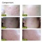 Medical Blue Light Therapy Laser Treatment Pen Original (
