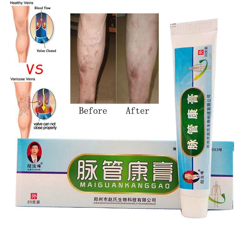 Varicose Veins Treatment Cream