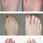 Elastic Bunion Corrector