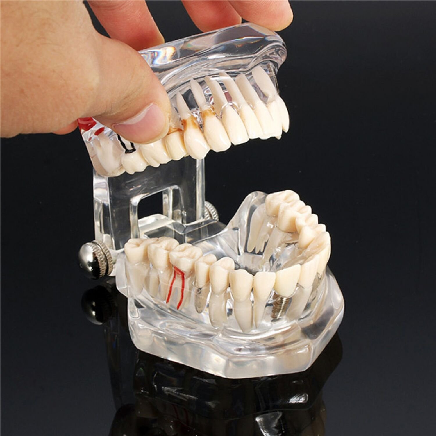 Dental Implant Disease Teeth Model Restoration Overdenture Demo Implants Tooth