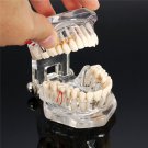 Dental Implant Disease Teeth Model Restoration Overdenture Demo Implants Tooth
