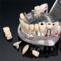 Dental Implant Disease Teeth Model Restoration Overdenture Demo Implants Tooth