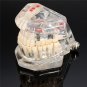 Dental Implant Disease Teeth Model Restoration Overdenture Demo Implants Tooth
