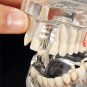 Dental Implant Disease Teeth Model Restoration Overdenture Demo Implants Tooth