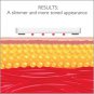 Silk’n Lipo - Targeted Fat Reduction Device