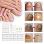 New Ingrown Toe Nail Correction Pedicure Fixer Straightener Clippers Recover Set