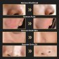 Facial Pore Cleanser Cleaner Face Blackhead Zit Acne Remover Skin Cleansing Tool