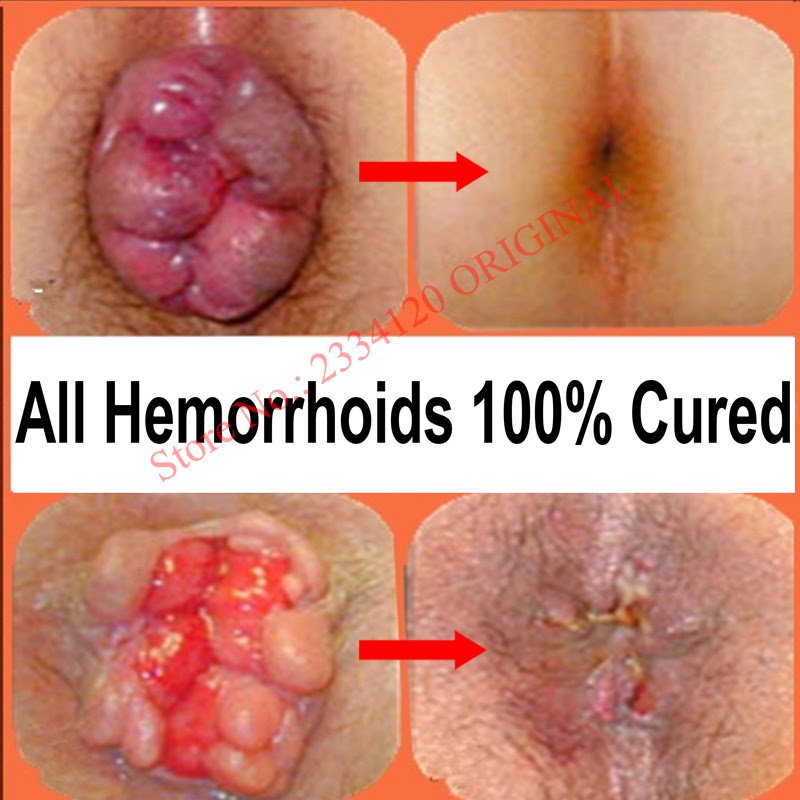 Warm Tips: 1.Exactly Hemorrhoid isn’t kind of horrible disease. 