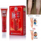 Varicose Veins Treatment Cream Ointment Vasculitis Phlebitis Spider Pain Angiitis Removal Herbal