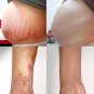 2 box Removal Acne Scar Stretch Marks Cream Fat Scar Striae Gravidarum Treatment