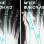 Bunion Toe Splint Support with Adjustable Ryotek Hinge (2-Pack) NIP