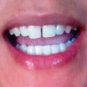 Treatment LED TEETH WHITENING KIT TOOTH WHITENER GEL BLEACH WHITE DENTAL