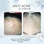 ANTI ACNE Set. Vulgaris Acne, clogged acne, ACNE DRY QUICKLY. Caviar+Lava Water