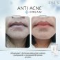 ANTI ACNE Set. Vulgaris Acne, clogged acne, ACNE DRY QUICKLY. Caviar+Lava Water