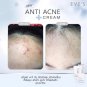 3 Steps Acne Clear Set. Pimples, clogged acne, inflamed Acne, ACNE DRY Quick