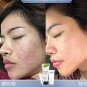 Acne Clear in 3 Steps. Pimples, clogged acne, Inflamed Acne, ACNE DRY Quick