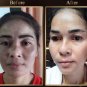 5x Horse Placenta. -Wrinkles Darkmarks Acnes.Glow Bright Revital. Q Double Serum