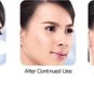 15G. DERMATIX ULTRA ADVANCED SCAR FORMULA GEL REDUCTION TREATMENT SURGERY KELOID
