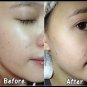 5 BARS x SNAIL WHITE ACNE WITH ZINC 10 X SPEED WHITENING&ACNE FACE SKIN 70 g.