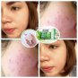 2BARS.ACNE SOAP 3D SMOOTH SOAP FOR REDUCE ACNE/STEROID ACNE/ FOR SENSITIVE SKIN