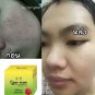 NEW!! HO-YEON ANTI-MALESMA FACIAL SOAP NATURAL INGREDIENTS RESTORE BRIGHTEN SKIN